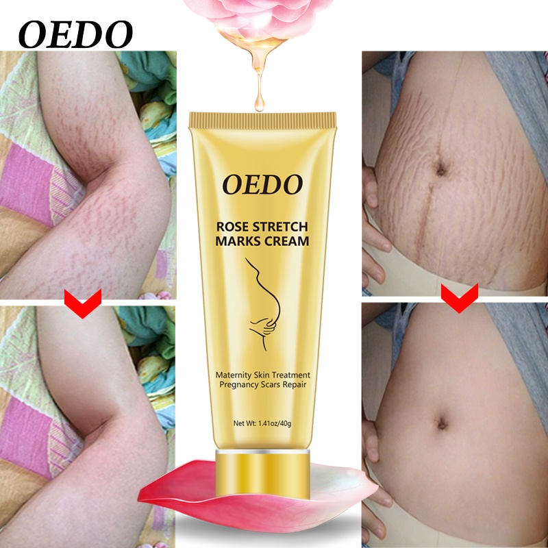 OEDO Rose Remove Stretch Marks Cream Anti Wrinkle Anti Aging Maternity Skin Repair Remove Pregnancy Scars Treatment Body Skin Care 40g #1