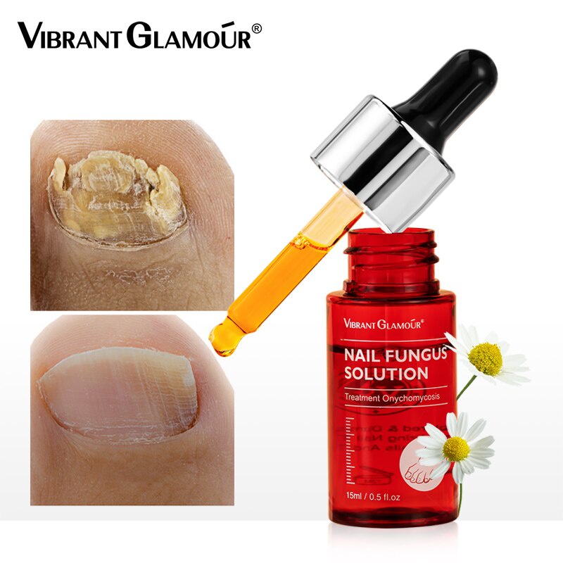 VIBRANT GLAMOUR Nail Repair Serum Fungus Onychomycosis Treatment Essence Removal Anti Fungus