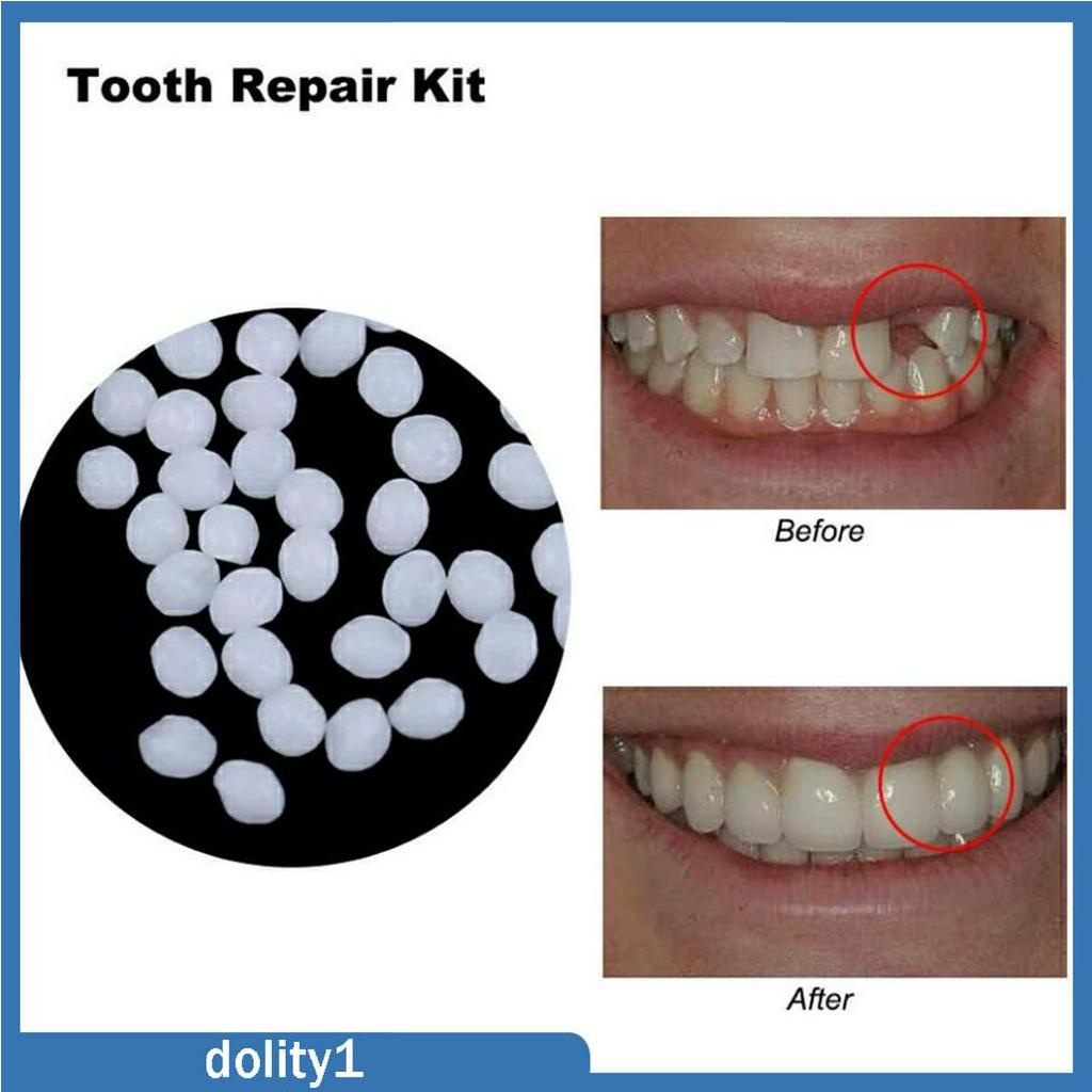 [DOLITY1] Dental Thermal Beads Teeth Veneers Moldable Denture Temporary