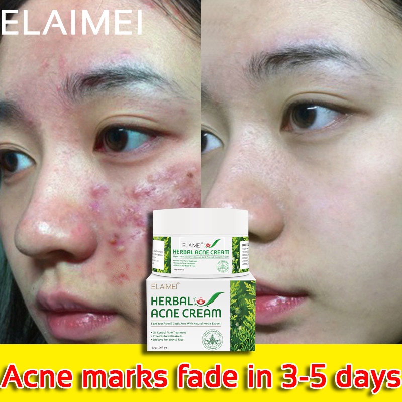 pimple remover cream acne marks remover cream skin care products anti