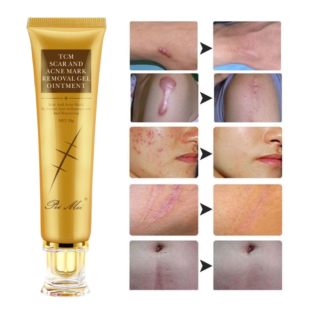efficient old Scar Remover for legs remover acne Surgical Marks Repair