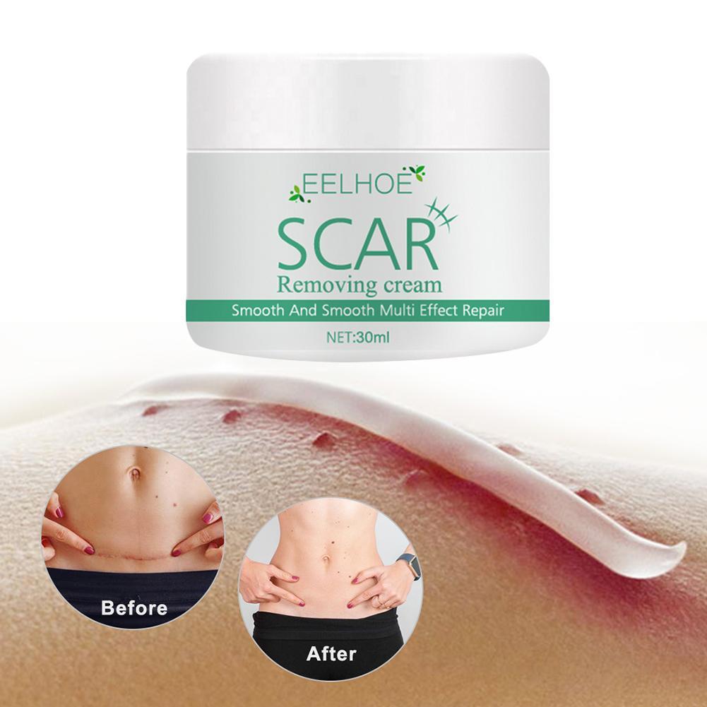 eelhoe scar removal cream
