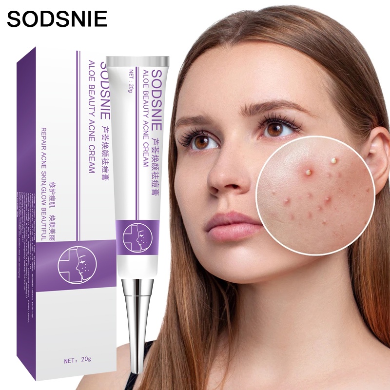 SODSNIE Aloe Vera Acne Cream Anti Acne Repair Pimple Marks Shrinking ...