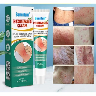 【Psoriasis Dermatitis Eczema Pruritus Itchy Cream 】psoriasis cream dermatitis cream eczema ointment