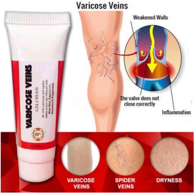 best cream for varicose veins on legs
