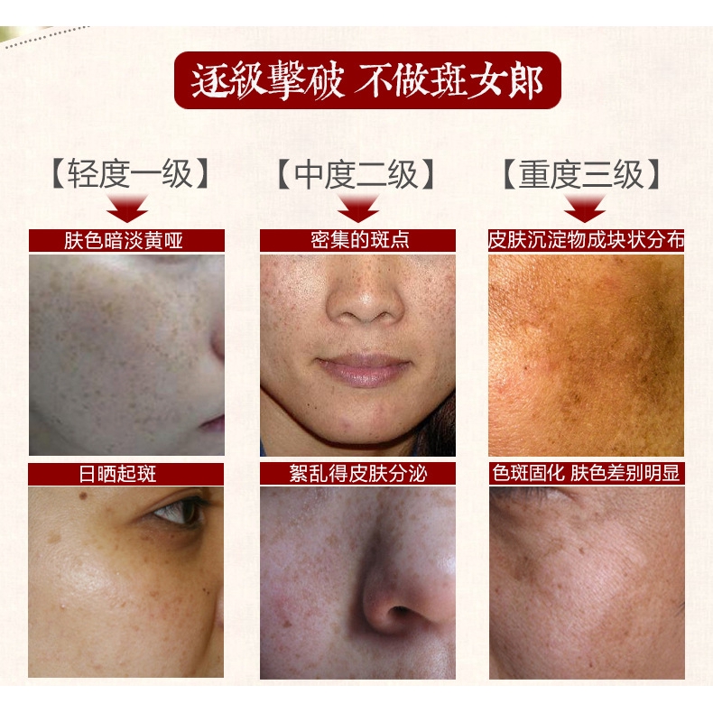 cream for light spots on face