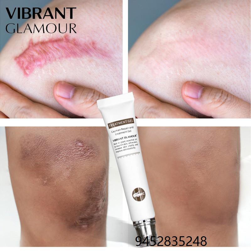 Scar Remover Cream Scars Repair Stretch Marks Pregnancy Scars Scalded Surgery Scar Removal Cream