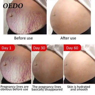 OEDO Rose Remove Stretch Marks Cream Anti Wrinkle Anti Aging Maternity Skin Repair Remove Pregnancy Scars Treatment Body Skin Care 40g #4