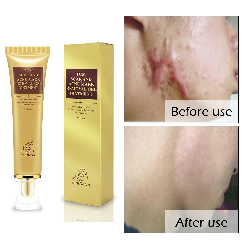 Acne Scars Treatment Philippines is rated the best in 09/2024 BeeCost