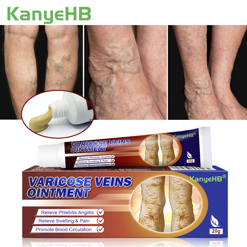 varicose vein remover cream Varicose Gel Veins Remover Pain Relief