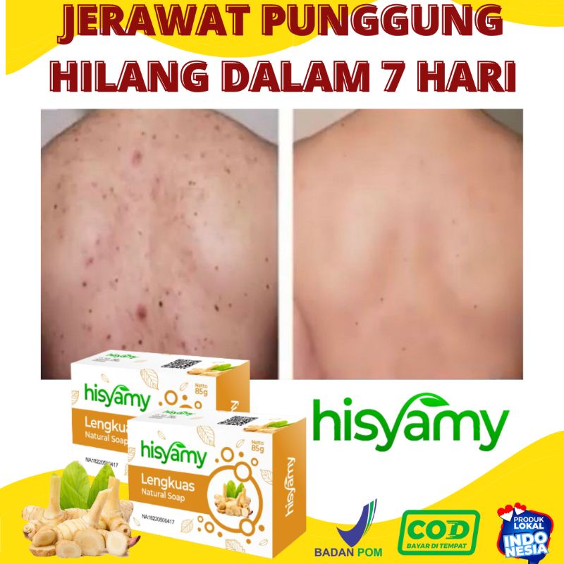 The Most Powerful Herbal Back Acne Soap, Hisham, Hisham, Removing