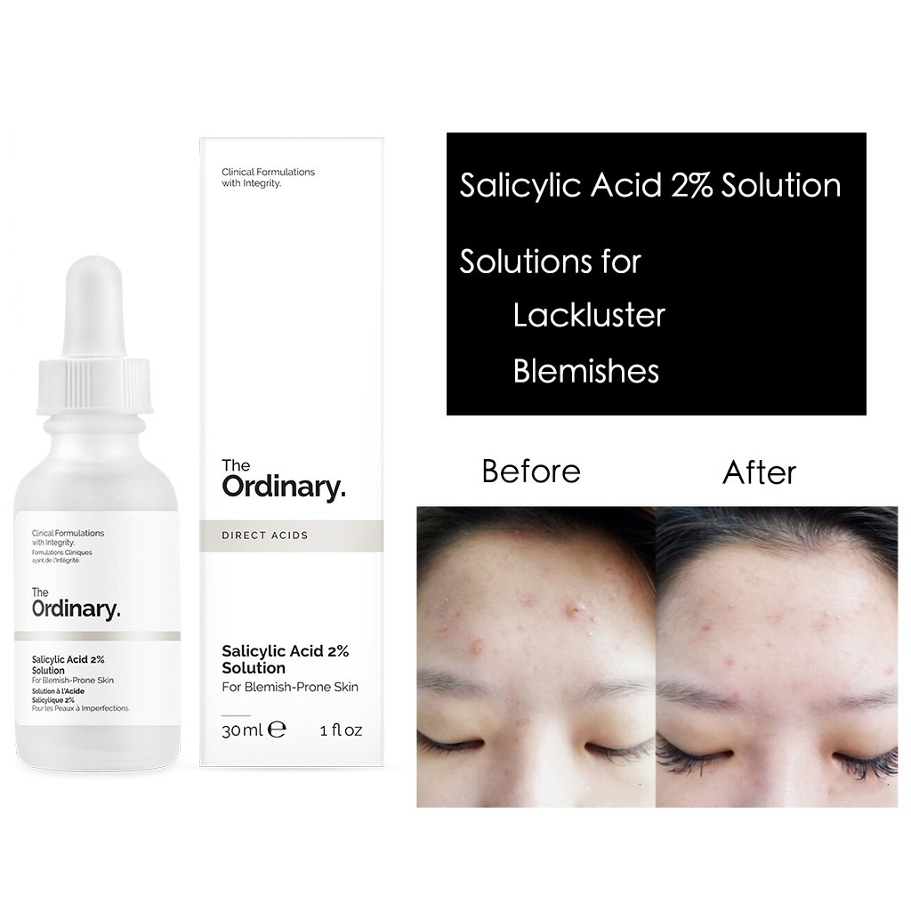 The Ordinary Salicylic Acid 2 Solution 30ml Acne Blemishes Facial Acid Shopee Philippines