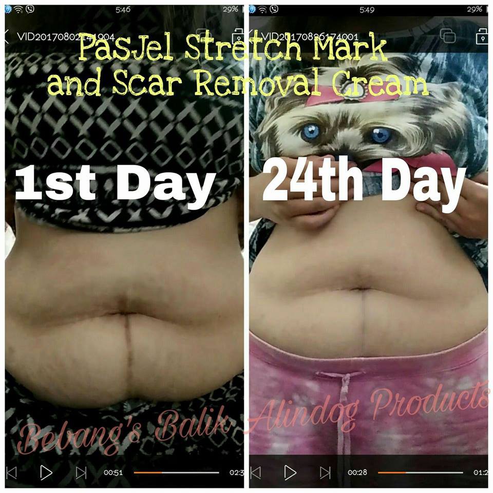 pasjel stretch mark removal