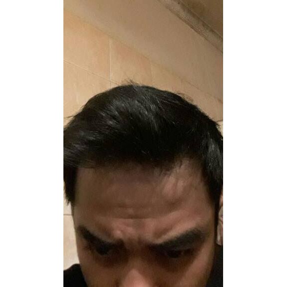 Best KIRKLAND MINOXIDIL 5 ORIGINAL COSTCO MADE IN ISRAEL And CANADA