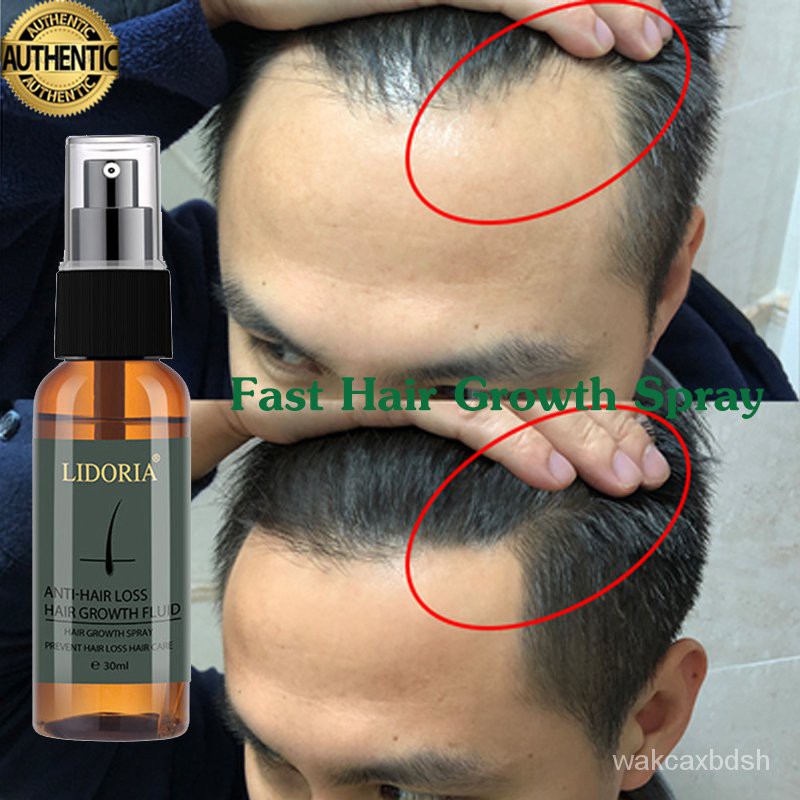 Spot Goods）Original hair grower for men women hair treatment for damage  hair spray growth booster h | Shopee Philippines
