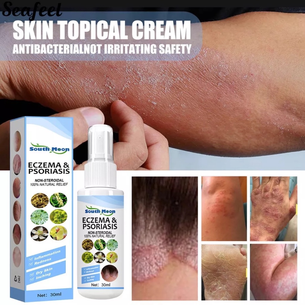 Eczema Psoriasis Spray Treatment Gamot Sa Kati Kati Sa Balat Buni Hadhad An An Alipunga Itchy 6696