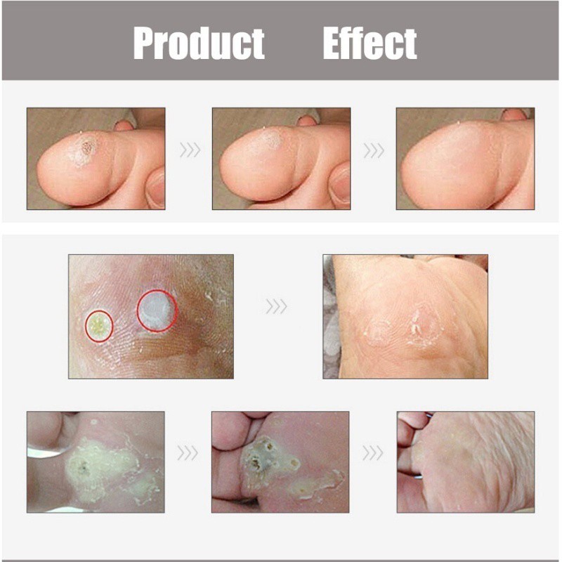 foot corn pain relief