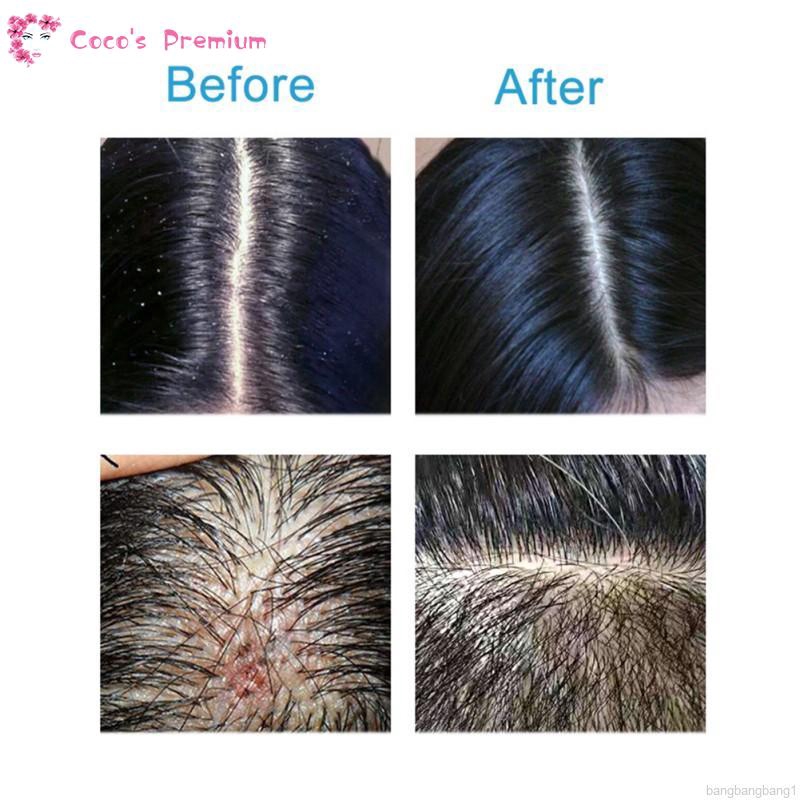 Coco Anti Dandruff Sea Salt Shampoo Relieve Itching Moisturize Soften  Anti-mite Hair Care Shampoo | Shopee Philippines