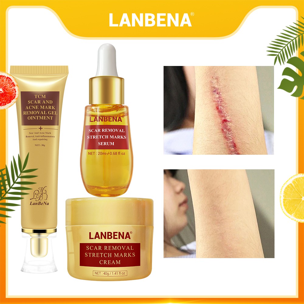 lanbena-tcm-scar-removal-cream-acne-spots-treatment-whitening-shopee