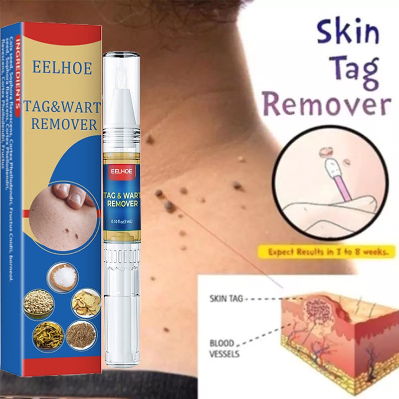 （Hot）【COD】 Second Half Pricewarts Removal Kasoy Oil Warts Remover Mole Remover Organic Cream Warts