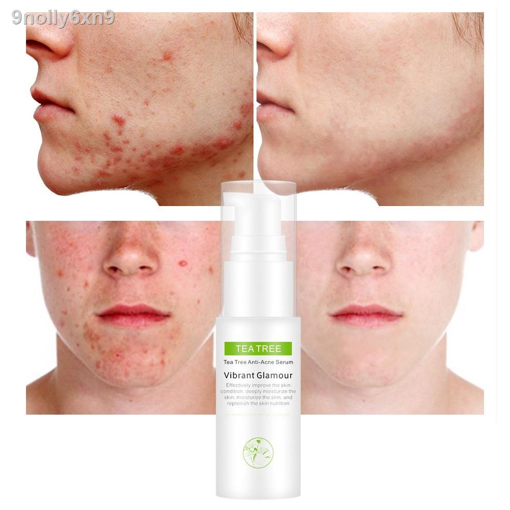 【Factory price】▧VIBRANT GLAMOUR Tea Tree Oil Acne Pimples Scars Treatment Facial Toner 30ml