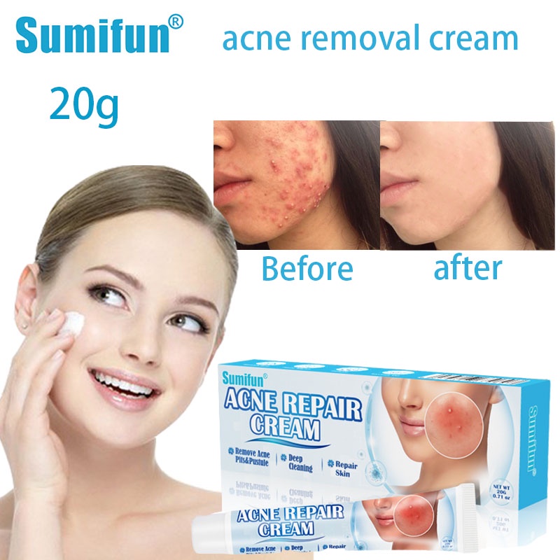 Antiacne cream acne remover treatment acne scar removal brightening