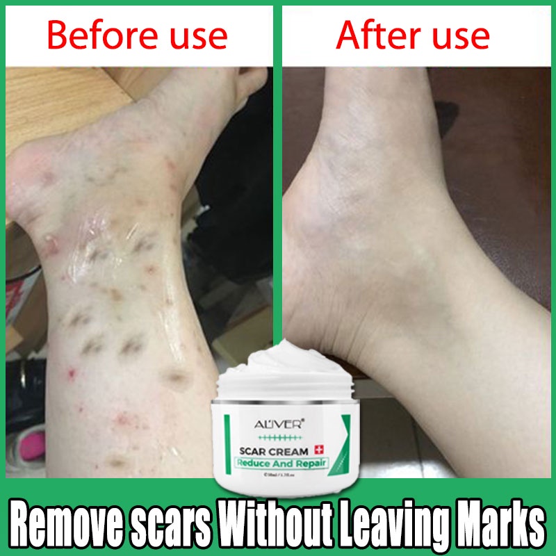ALIVER Scar Removal Cream Remove Scar Gel Acne Scars Treatment Acne
