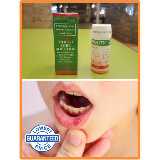 THE ORIGINAL AND EFFECTIVE CANKER MOUTH SORE SOLUTION! GAMOT SA SINGAW