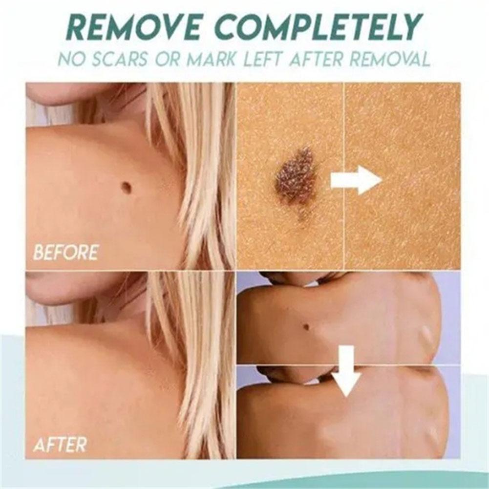 Ultra Strength Natural Health Mole Nevus Wart Skin Foot Tag Warts Tag Removal Corn Skin O3X5