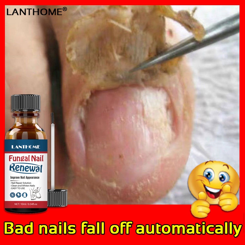 Lanthome Nail Repair liquid Treat onychomycosis(Anti Nail Fungus Fungal