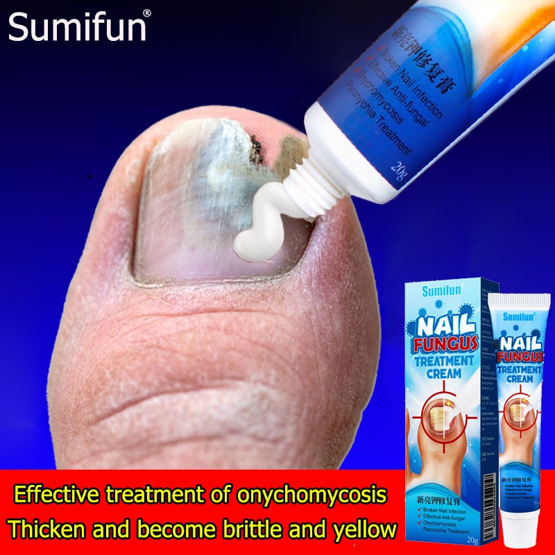 Antibacterial Cream Anti Fungal Cream Nail Fungus Treatment Paronychia Nail Care Repair Ointment