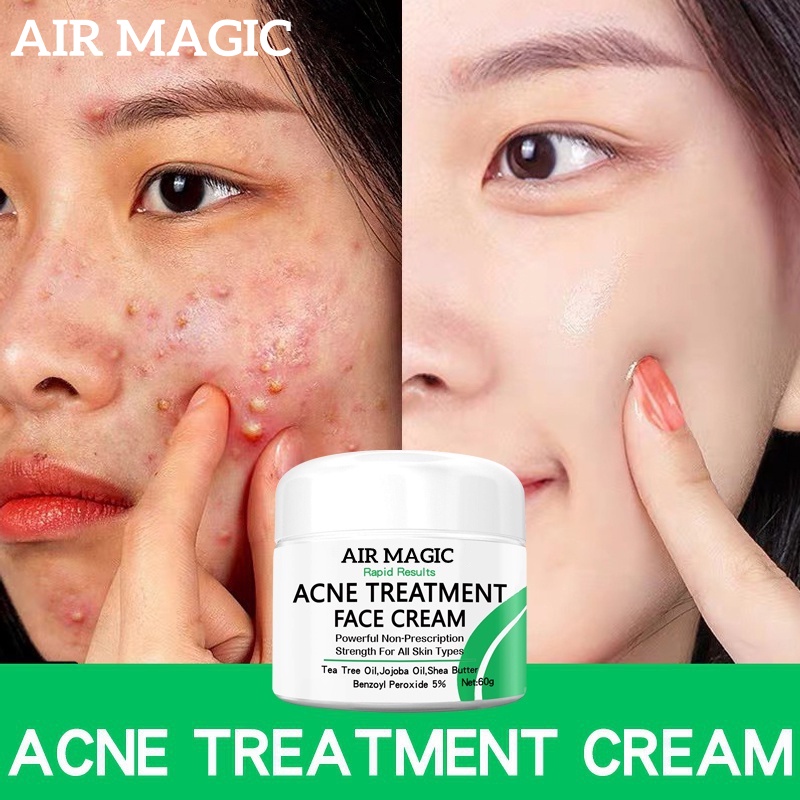 AIR MAGIC Acne Treatment Cream Anti Acne Face Cream Pimple Removal ...