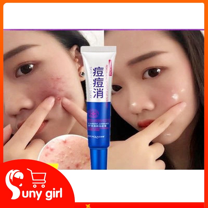 hemorrhoid cream for acne