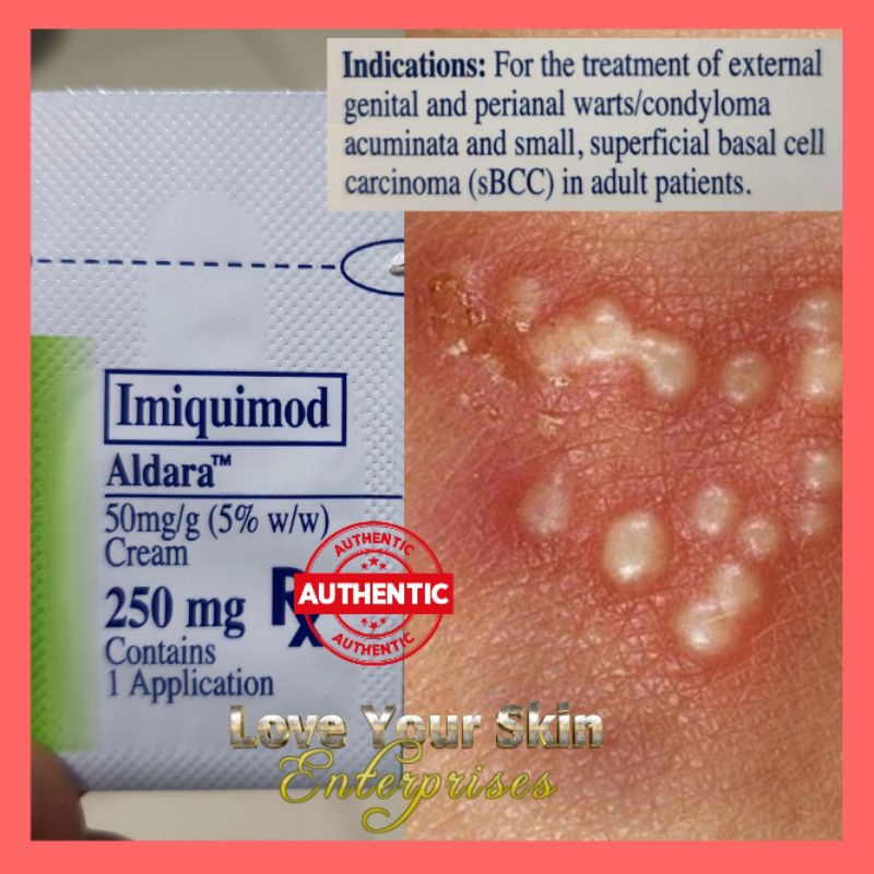 ALDARA WARTS CREAM 2 SACHETS ONLY Shopee Philippines