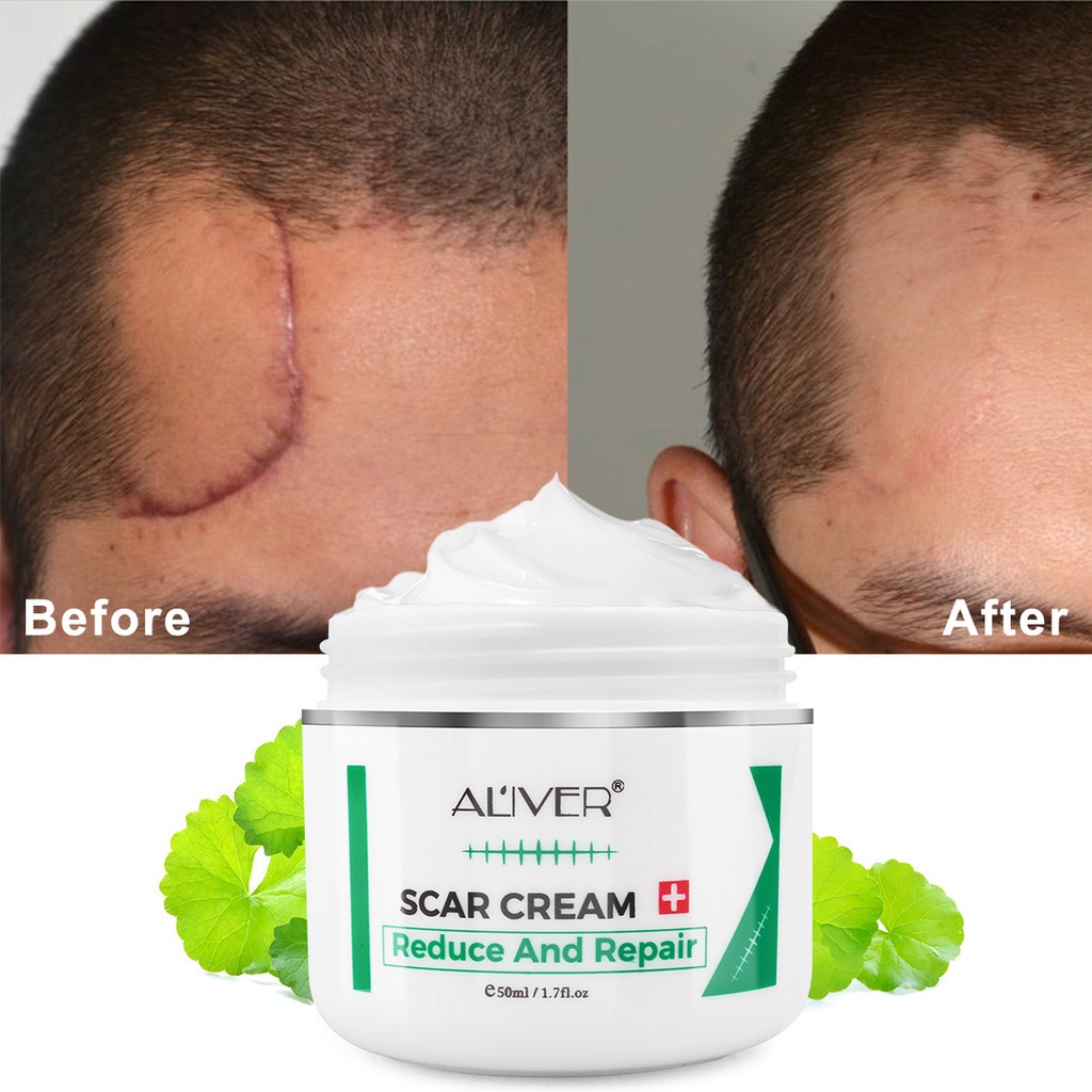 Scar Remover Cream for New Old Scars on Legs Face Body Scar Remove ...