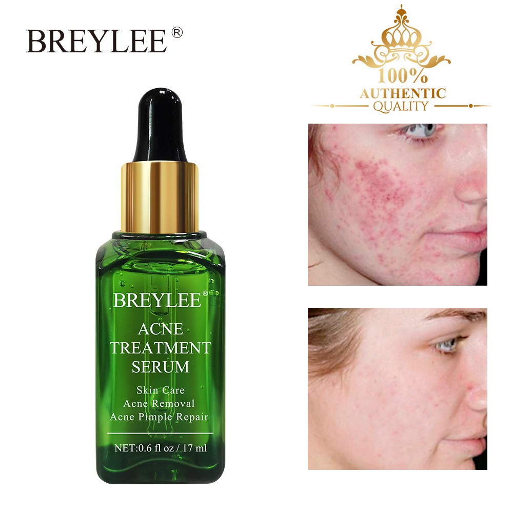 BREYLEE Acne Treatment Serum Anti Acne Scar Removal Cream Whitening