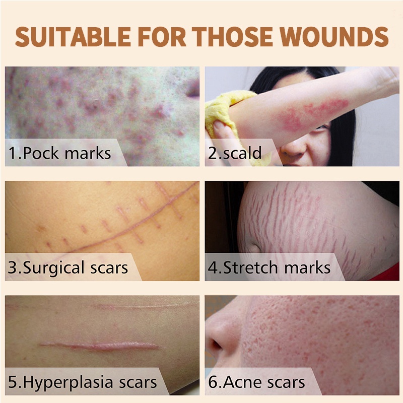 HEMEIEL Magic Scar Remover Gel Original/Scar removal for old scars