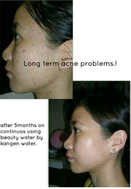 kangen water acne treatment
