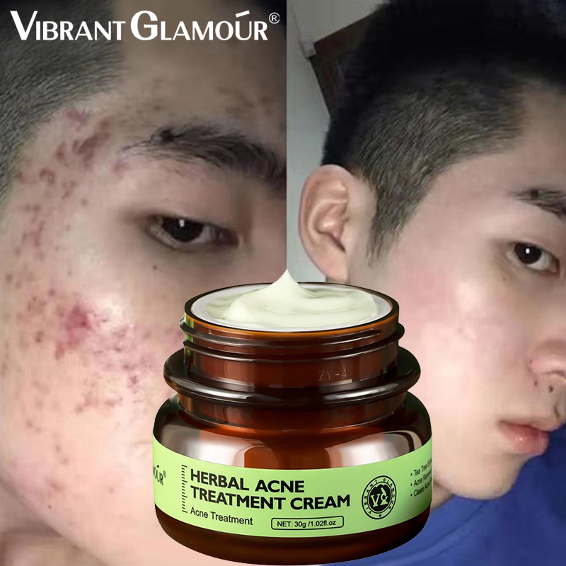 Acne remover Pimple Remover Marks keep face moisturized, whiten skin