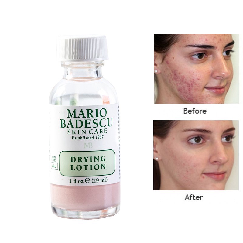 Mario Badescu Drying Lotion Acne Spot Treatment Drying Lotion Fast Acting Formula For Clearing Severe Acne From Face And Body Shopee Philippines