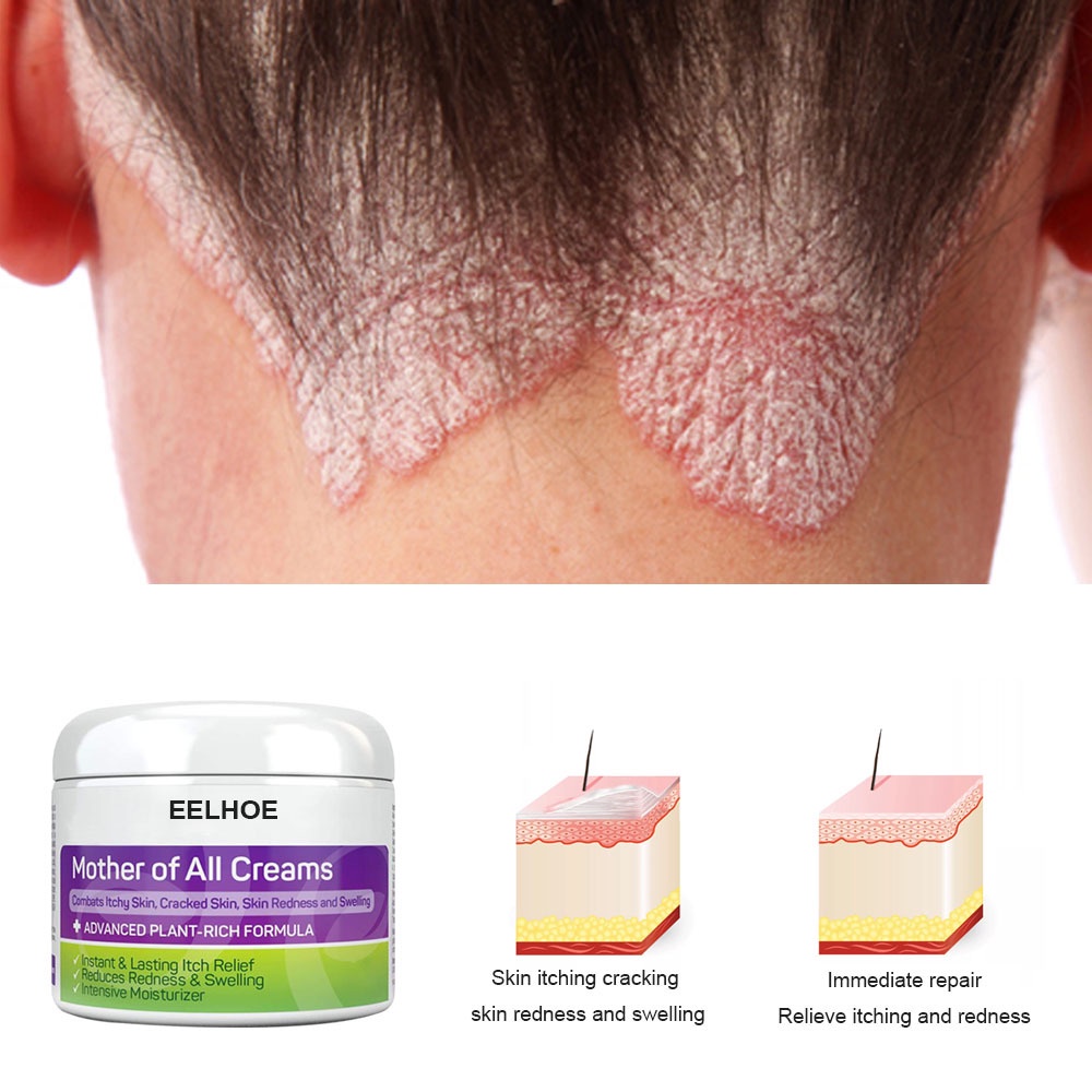 Eczema Cream AntiItch Cream Skin Topical Repair High Quality Psoriasis
