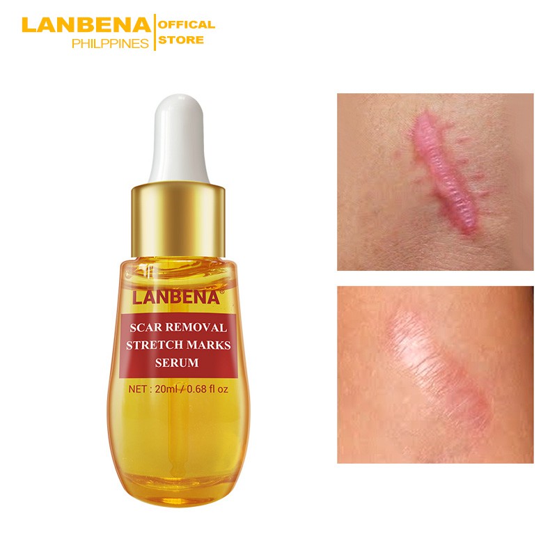 lanbena stretch mark