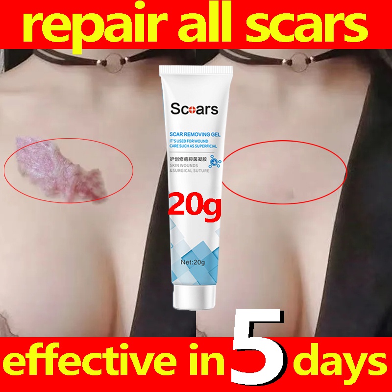 Scar Removal Cream Scars Stretch Marks Cream Peklat Remover Acne Treatment Scar Repairing Gel