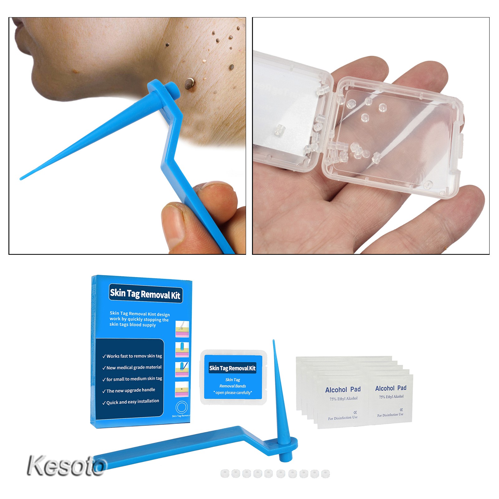 [kesoto] Skin Tag Kill Skin Mole Wart Remover Band Skin Tag Removal Kit With Cleansing Pads