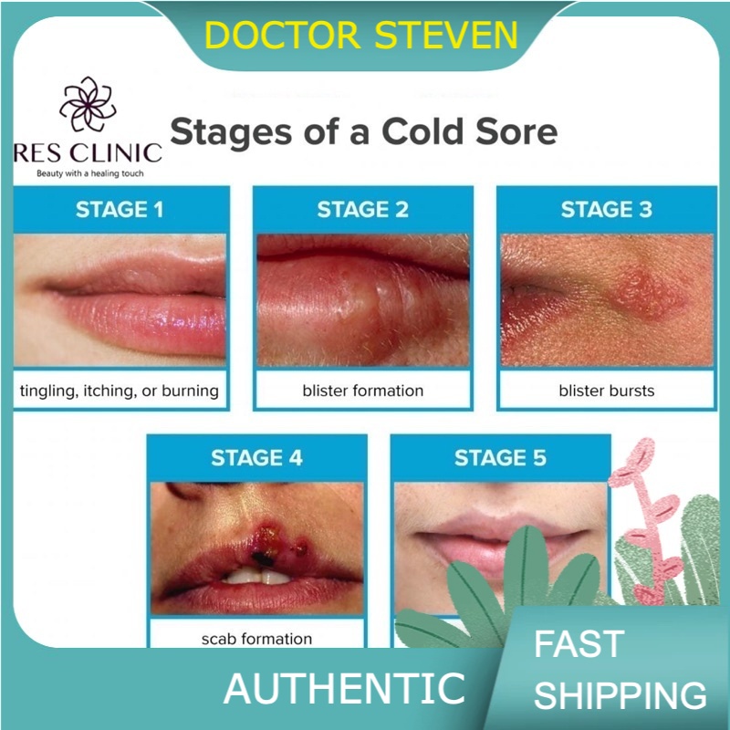 Cold Sore Herpes Shingles Healing Medicated Ointment Cream 10g Jd9r ...