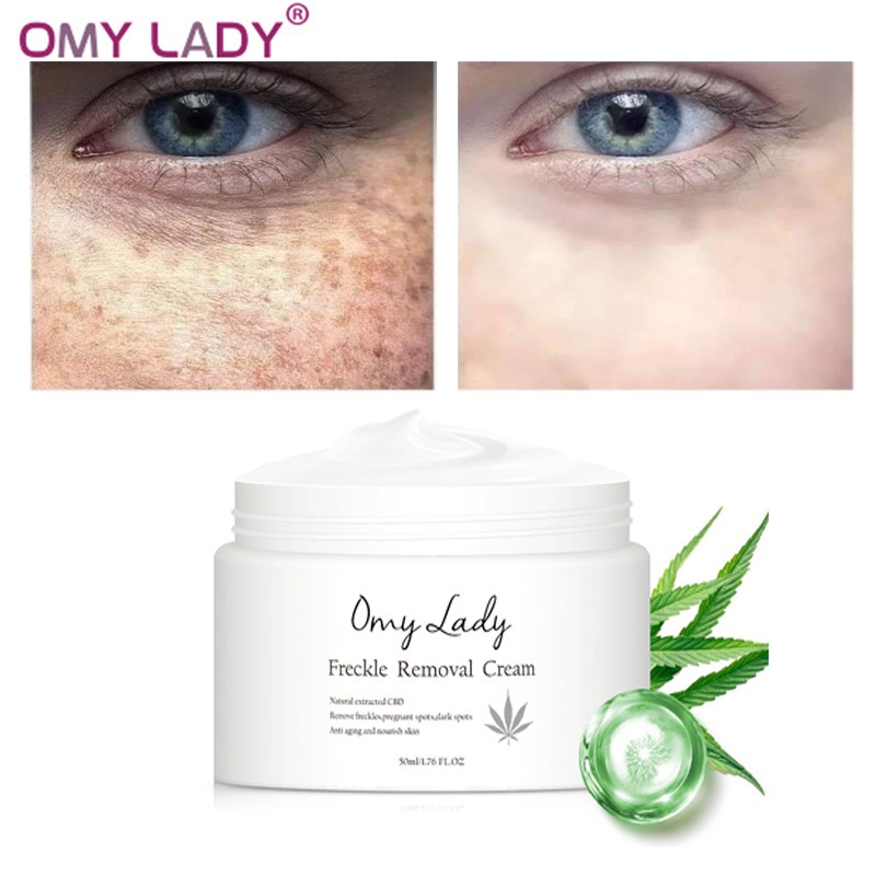 OMY LADY Freckle Removal Face Cream 50g Shopee Philippines