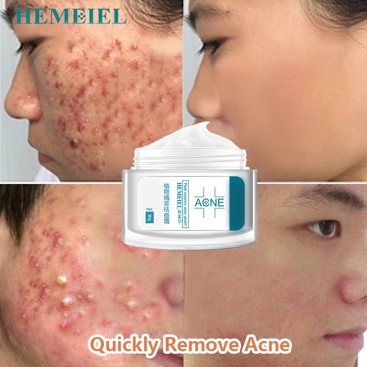 HEMEIEL Pimple Marks Remover Cream / Pimple marks remover / Pimples