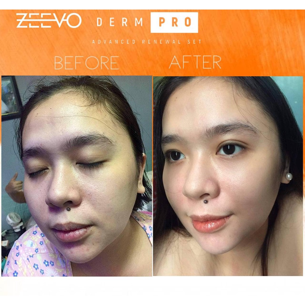 Zeevo Derm Pro - Advanced Renewal Set | Gently Expoliates and Helps even  skin tone | Shopee Philippines