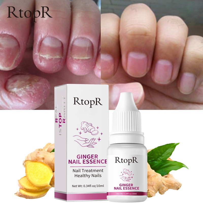 RtopR Ginger Antibacterial Nail Treatment Essential Anti Fungal