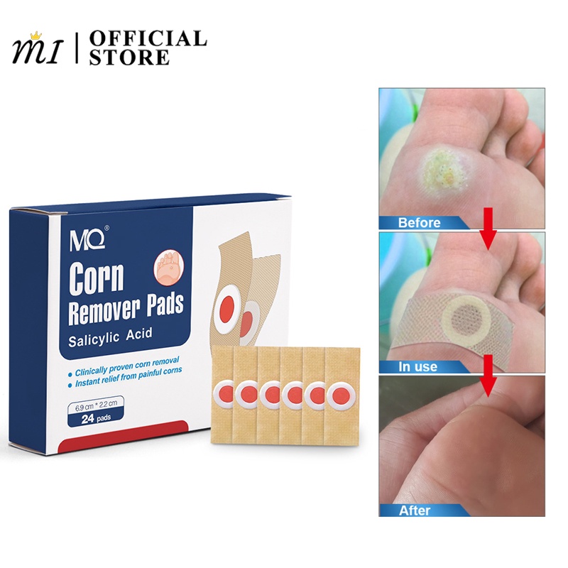 24PCS Warts remover Foot Corns Remover Patch To remove calluses on the